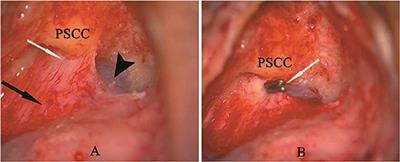 Dynamics in Endolymphatic Hydrops & Symptoms in Meniere's Disease After Endolymphatic Duct Blockage, Preliminary Results